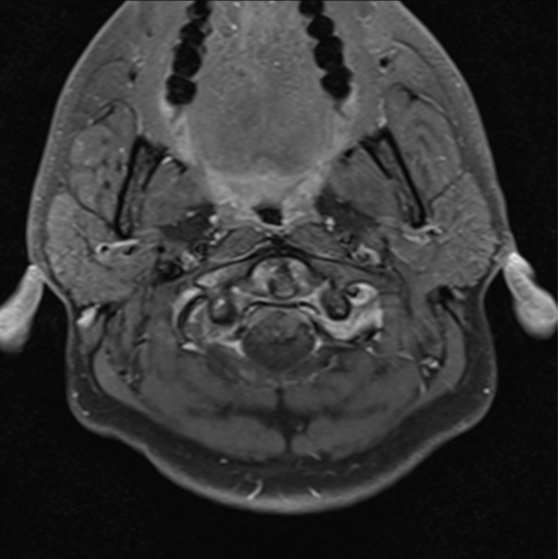 File:Cerebellar hemangioblastomas and pituitary adenoma (Radiopaedia 85490-101176 Axial T1 C+ fat sat 1).png