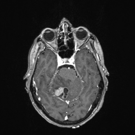 Cerebellar metastases (Radiopaedia 24038-24249 Axial T1 C+ 28).jpg