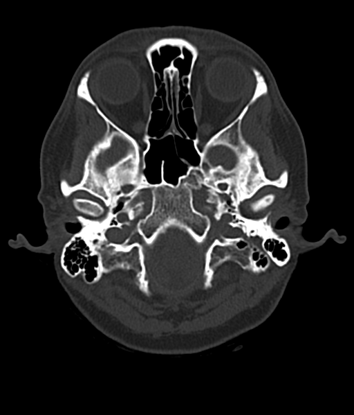 Cerebellar metastases - colorectal adenocarcinoma (Radiopaedia 40947-43652 AX Bone C- 2.0 MPR 7).png