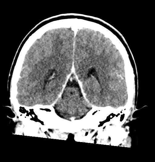 Cerebellar metastases - colorectal adenocarcinoma (Radiopaedia 40947-43652 Coronal C+ 58).png