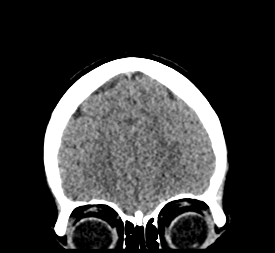 File:Cerebellar metastases - colorectal adenocarcinoma (Radiopaedia 40947-43652 Coronal non-contrast 24).png