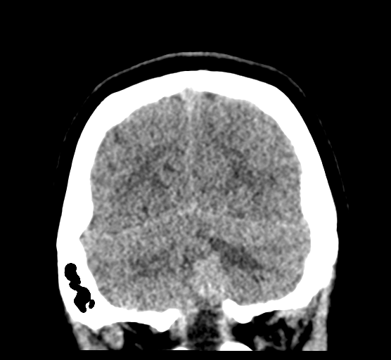 Cerebellar metastases - colorectal adenocarcinoma (Radiopaedia 40947-43652 Coronal non-contrast 78).png