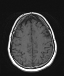 File:Cerebellar metastasis (Radiopaedia 54578-60810 Axial T1 29).png