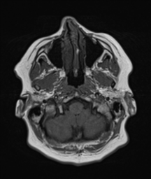 File:Cerebellar metastasis (Radiopaedia 54578-60810 Axial T1 5).png