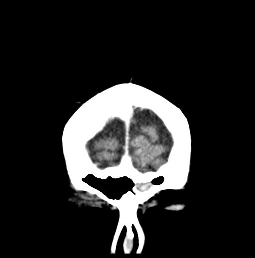 Cerebellar metastasis (Radiopaedia 54578-60812 Coronal C+ 4).png