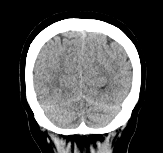 File:Cerebellar metastasis (Radiopaedia 54578-60812 Coronal non-contrast 50).png