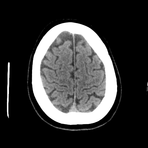 Cerebellar metastasis (cystic appearance) (Radiopaedia 41395-44258 Axial non-contrast 44).png