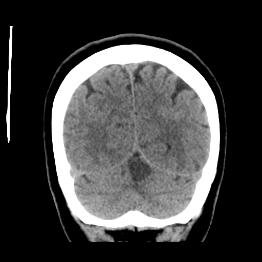 Cerebellar metastasis (cystic appearance) (Radiopaedia 41395-44258 Coronal non-contrast 49).png