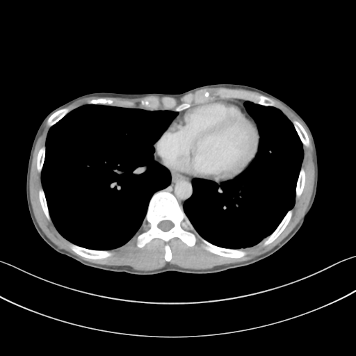Cerebellar metastasis - adenocarcinoma lung (Radiopaedia 63184-71717 Axial C+ delayed 45).png