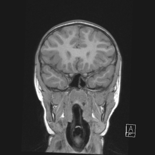 Cerebellar stroke (Radiopaedia 32202-33150 Coronal T1 20).png