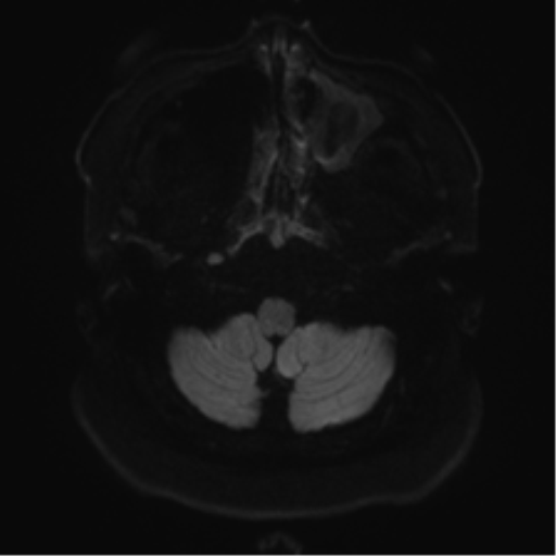 Cerebellopontine angle meningioma (Radiopaedia 48434-53348 Axial DWI 40).png