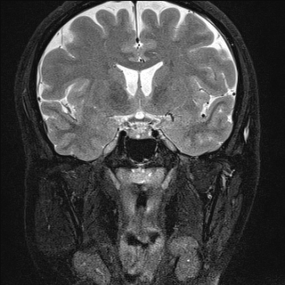 File:Cerebellopontine angle meningioma (Radiopaedia 53561-59591 Coronal T2 2).jpg