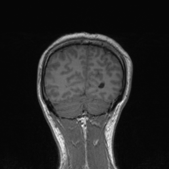 Cerebral abscess (Radiopaedia 24212-24478 Coronal T1 166).jpg