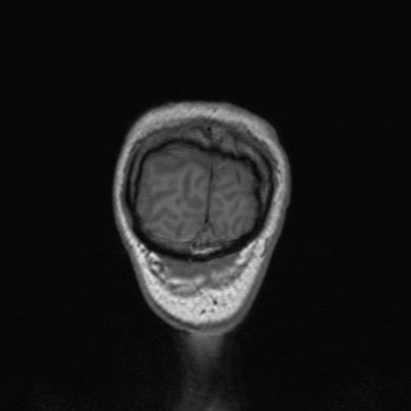Cerebral abscess (Radiopaedia 24212-24478 Coronal T1 186).jpg