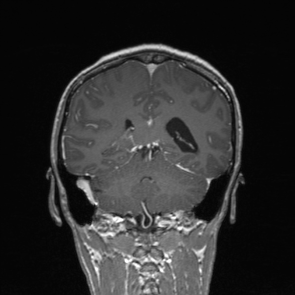 Cerebral abscess (Radiopaedia 24212-24478 Coronal T1 C+ 140).jpg
