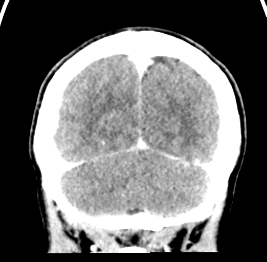 Cerebral abscess (Radiopaedia 60342-68008 Coronal C+ delayed 54).png