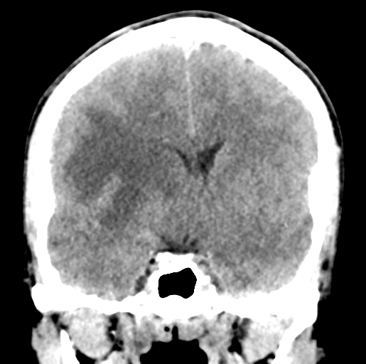 Cerebral abscess (Radiopaedia 60342-68008 Coronal non-contrast 29).png