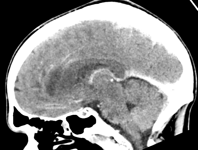 Cerebral abscess (Radiopaedia 60342-68008 Sagittal C+ delayed 24).png