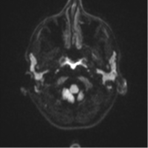 Cerebral abscess (Radiopaedia 60342-68009 Axial DWI 38).png