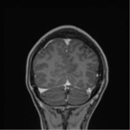 File:Cerebral abscess (Radiopaedia 60342-68009 H 5).png