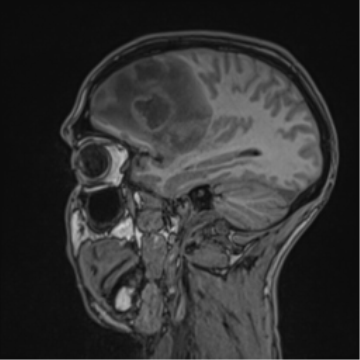 Cerebral abscess (Radiopaedia 60342-68009 Sagittal T1 40).png