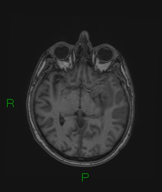 Cerebral abscess and subdural empyema (Radiopaedia 84436-99779 Axial T1 48).jpg