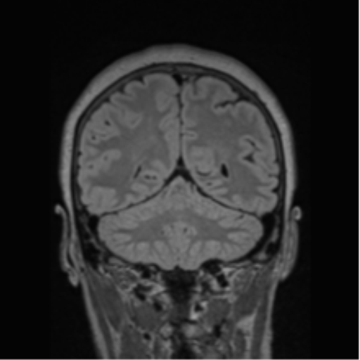 Cerebral abscess from pulmonary arteriovenous malformation (Radiopaedia 86275-102291 Coronal FLAIR 29).png