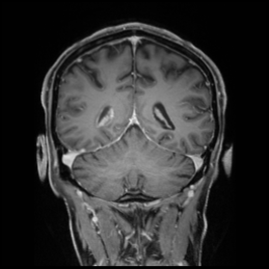Cerebral abscess with ventriculitis (Radiopaedia 78965-91878 Coronal T1 C+ 45).jpg