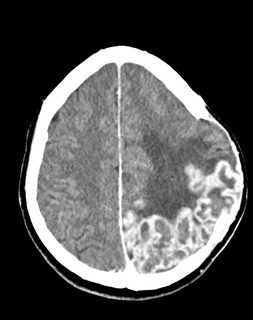 Cerebral abscesses (Radiopaedia 70458-80568 Axial Contrast 45).jpg