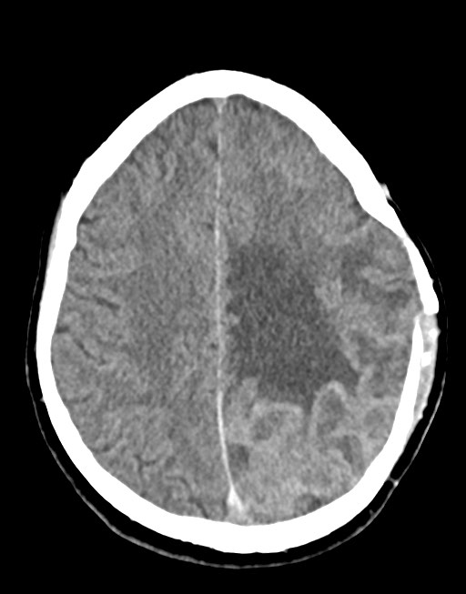 Cerebral abscesses (Radiopaedia 70458-80568 Axial non-contrast 43).jpg