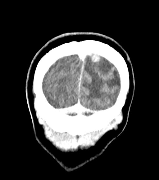 Cerebral abscesses (Radiopaedia 70458-80568 Coronal Contrast 60).jpg