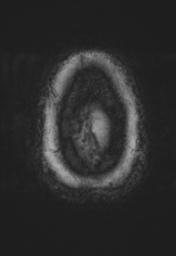 File:Cerebral amyloid angiopathy (Radiopaedia 29129-29518 Axial SWI Magnitude 37).jpg