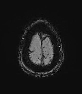 Cerebral amyloid angiopathy (Radiopaedia 46082-50433 Axial SWI 81).png