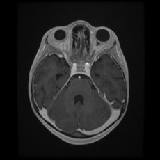 Cerebral and spinal tuberculosis (Radiopaedia 90489-107837 Axial T1 C+ 71).jpg