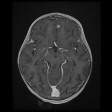 File:Cerebral and spinal tuberculosis (Radiopaedia 90489-107837 Axial T1 C+ 89).jpg