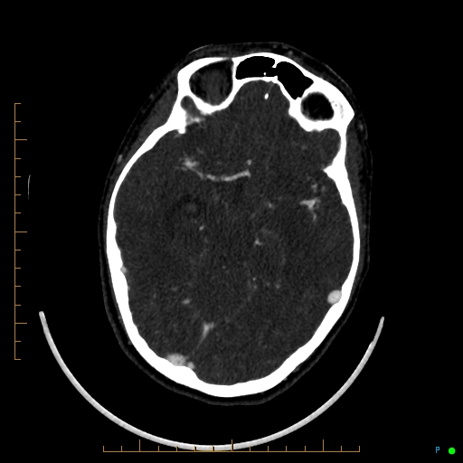 Cerebral arteriovenous malformation (AVM) (Radiopaedia 78162-90706 Axial CTA 120).jpg