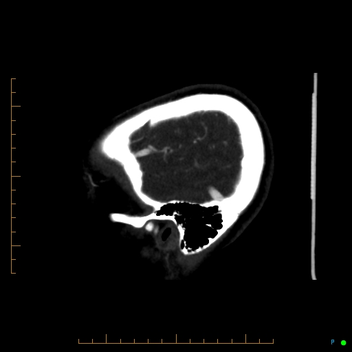 Cerebral arteriovenous malformation (AVM) (Radiopaedia 78162-90706 Sagittal CTA 12).jpg