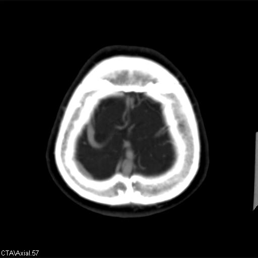 File:Cerebral arteriovenous malformation (Radiopaedia 28518-28759 B 57).jpg