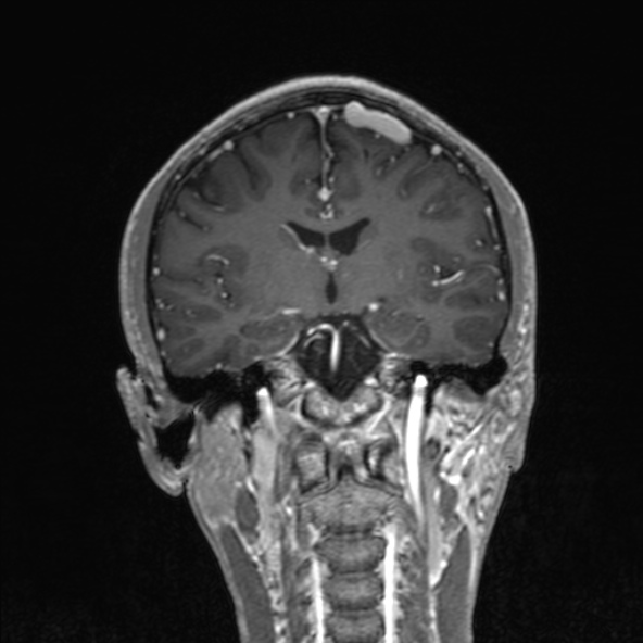 Cerebral arteriovenous malformation (Radiopaedia 30198-30813 F 31).jpg