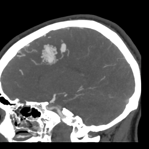 Cerebral arteriovenous malformation (Radiopaedia 39259-41505 Sagittal 26).png