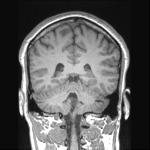 File:Cerebral arteriovenous malformation (Radiopaedia 39259-41506 Coronal T1 34).png