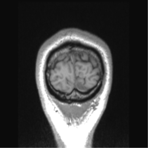 Cerebral arteriovenous malformation (Radiopaedia 39259-41506 Coronal T1 8).png