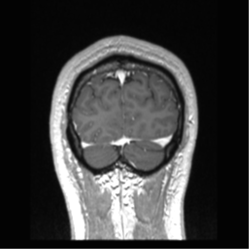 Cerebral arteriovenous malformation (Radiopaedia 39259-41506 Coronal T1 C+ 14).png