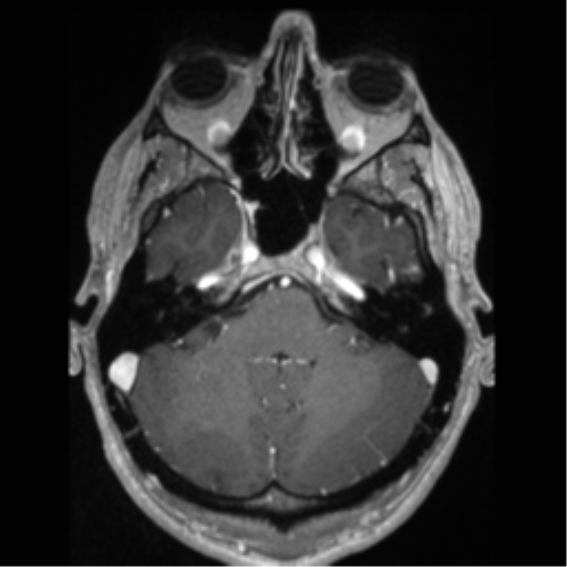 Cerebral arteriovenous malformation (Radiopaedia 55798-62372 Axial T1 C+ 17).png