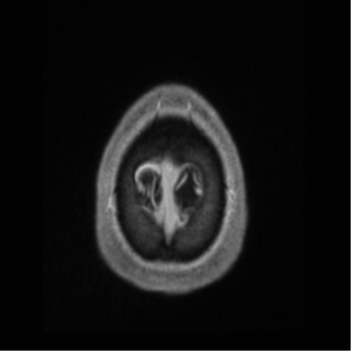 Cerebral arteriovenous malformation (Radiopaedia 55798-62372 Axial T1 C+ 74).png