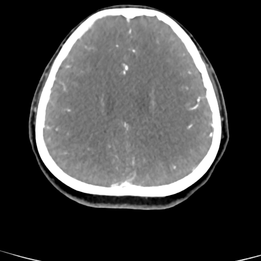 Cerebral arteriovenous malformation (Radiopaedia 73830-84645 B 34).jpg