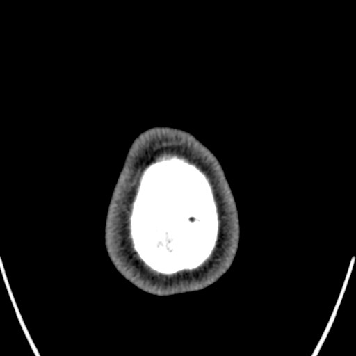 Cerebral arteriovenous malformation (Radiopaedia 78188-90746 Axial non-contrast 179).jpg
