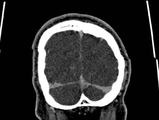 Cerebral arteriovenous malformation (Radiopaedia 78188-90746 Coronal C+ delayed 115).jpg