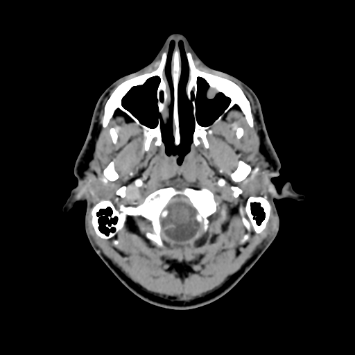 File:Cerebral arteriovenous malformation (Spetzler-Martin grade 2) (Radiopaedia 41262-44076 Axial C+ 4).png