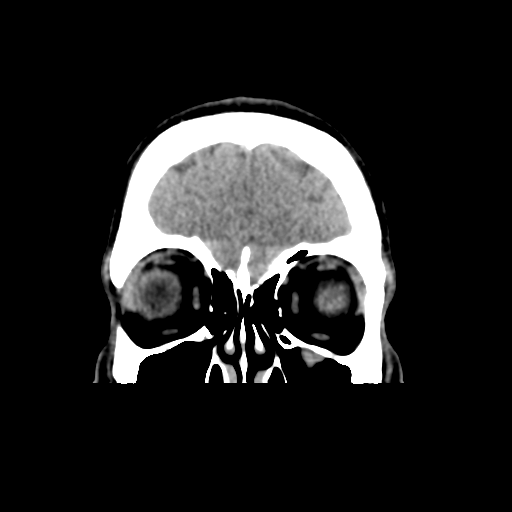 Cerebral arteriovenous malformation (Spetzler-Martin grade 2) (Radiopaedia 41262-44076 Coronal non-contrast 9).png